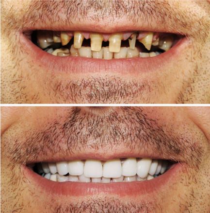 Rehabilitacion oral